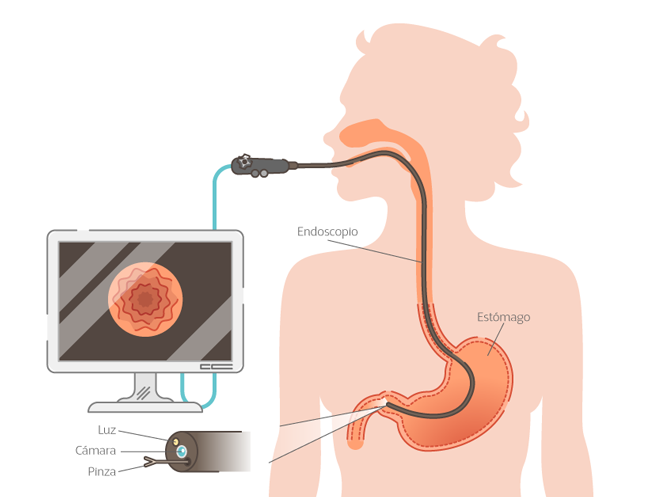 Con la endoscopia gastrointestinal se obtienen im�genes de alta resoluci�n para diagn�sticos acertados