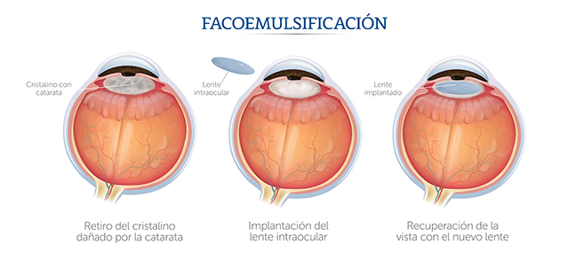 Fases de una cirug�a de cataratas