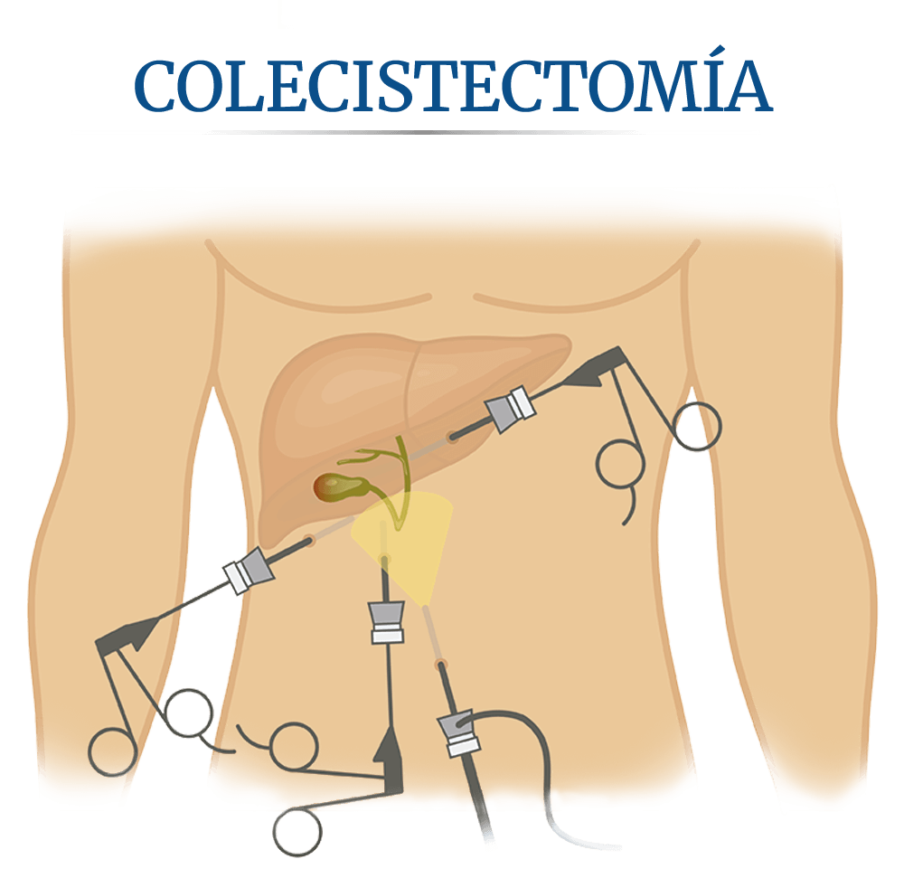 C�lculos en la ves�cula, colecistectom�a o cirug�a de la ves�cula biliar